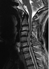 頚椎症性脊髄症/MRI